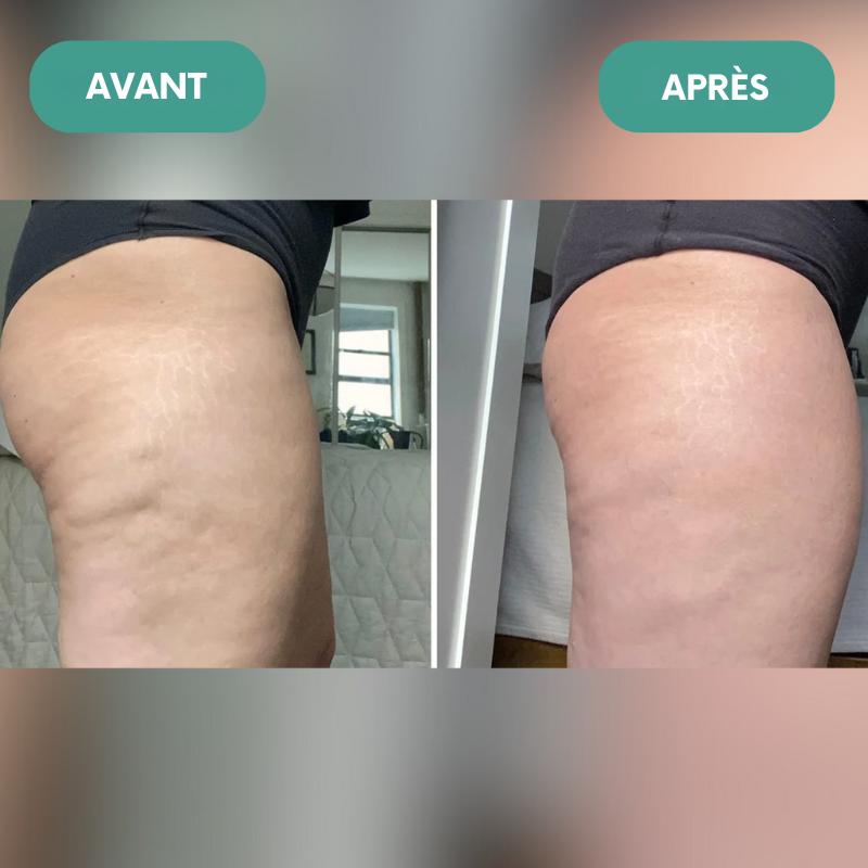 CelluBloom : Masseur Anti-Cellulite + Huile Offerte