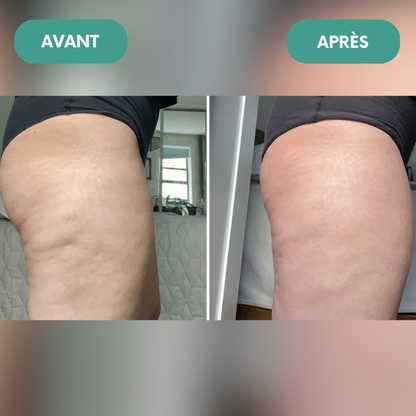 CelluBloom : Masseur Anti-Cellulite + Huile Offerte